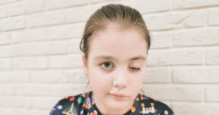 Пилоидная астроцитома левой средней ножки мозжечка и моста ...