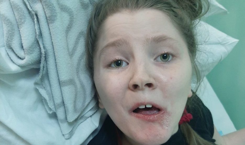 Кате нужен программируемый шунт для лечения гидроцефалии.