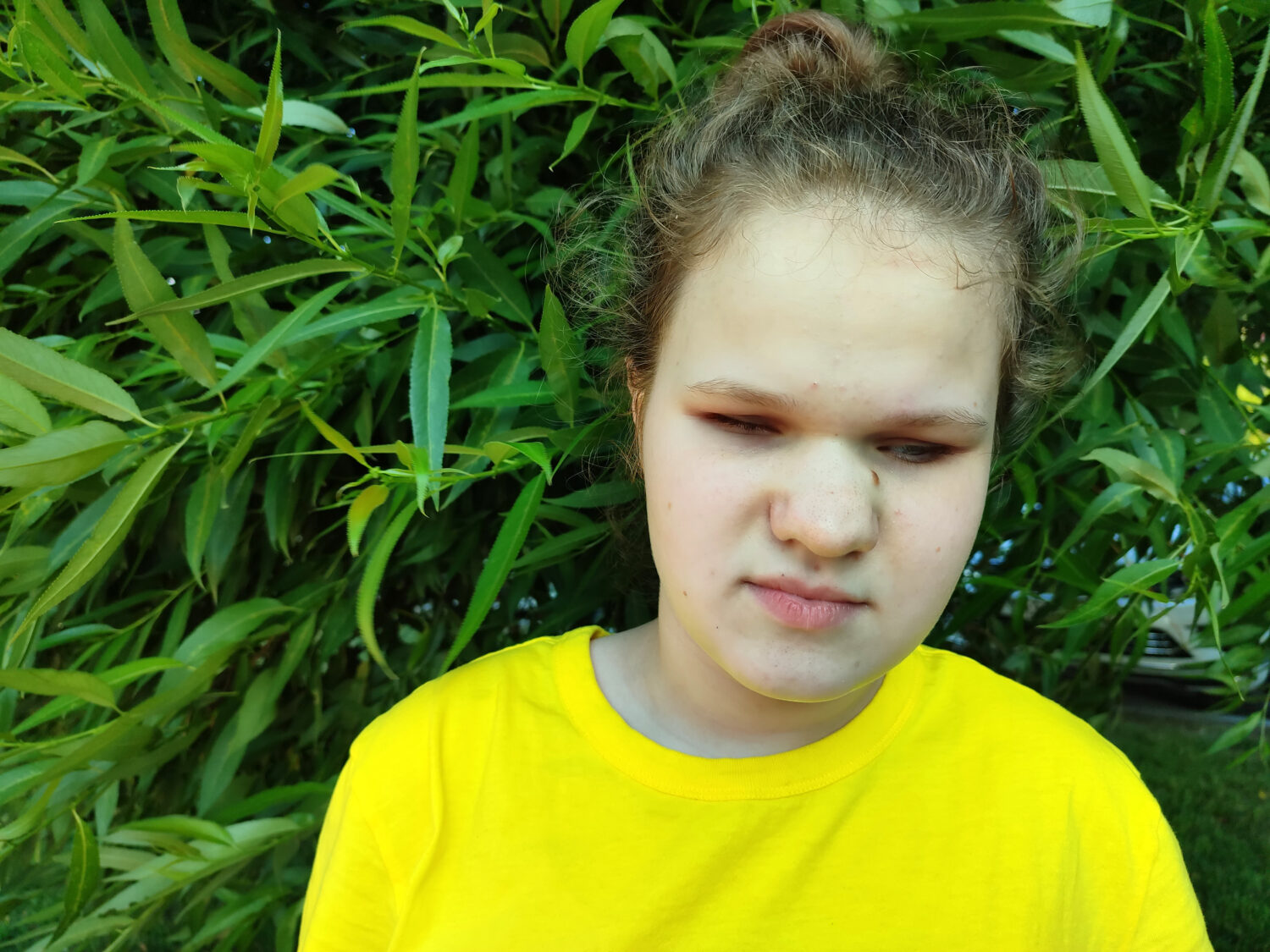 Падалко Светлана. Света не видит с двух лет, а сейчас её состояние ...