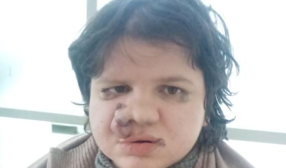 Девушка страдает от генетического заболевания - синдрома Маффуччи